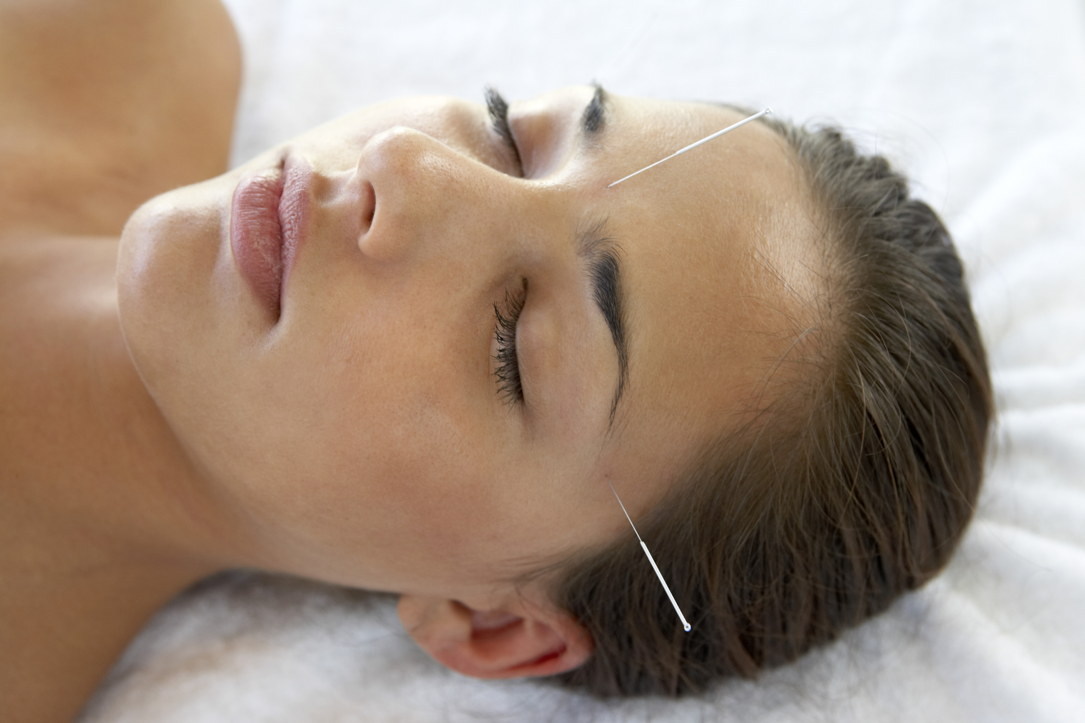 acupuncture-to-cure-headaches