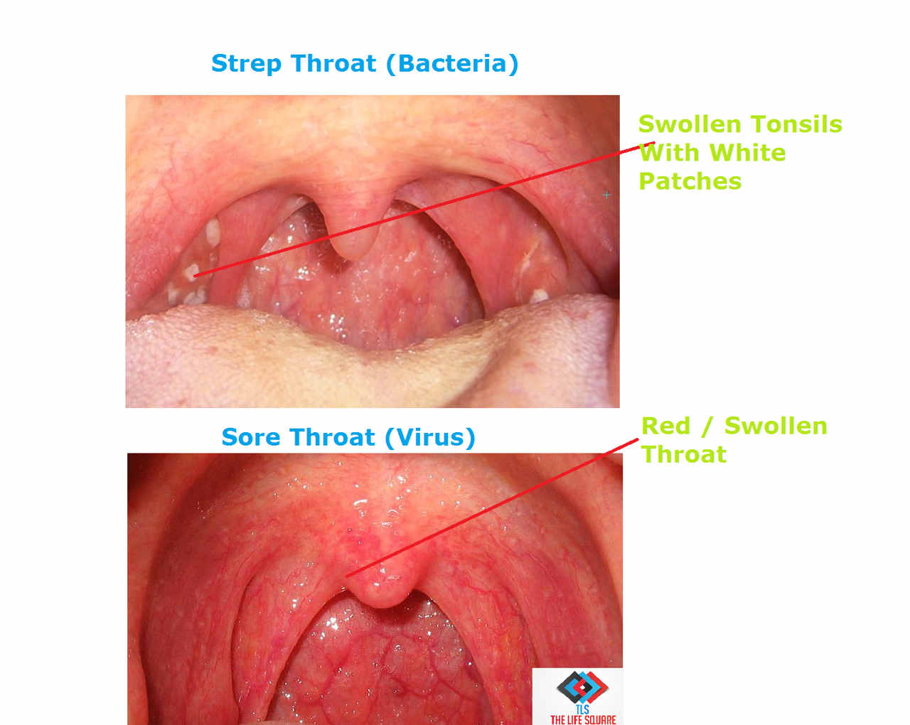 Strep Throat Pictures Without Tonsils 7