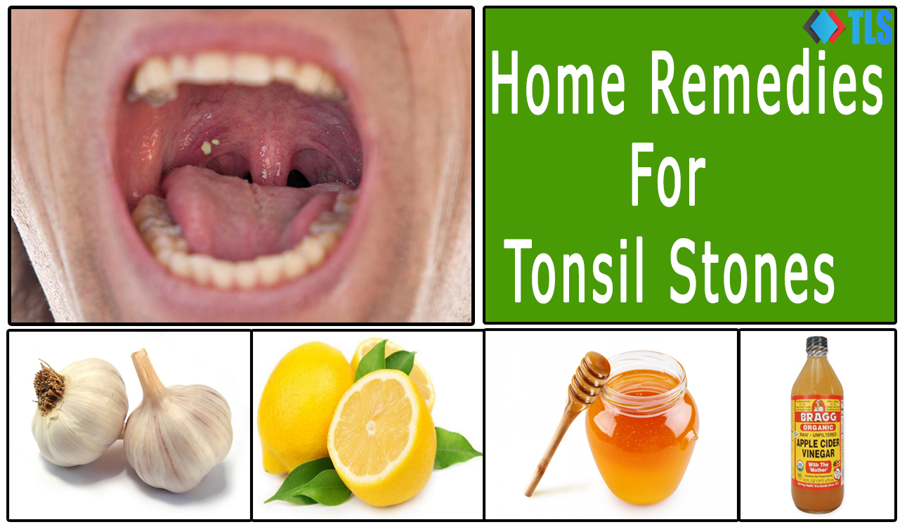 Home Remedies for Tonsil Stones
