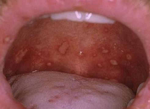 Oral Spots 76