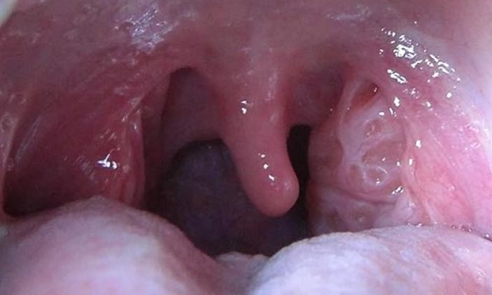 swollen tonsils no pain
