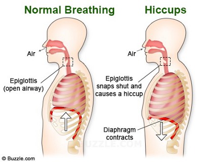 Causes of Hiccups