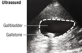 Gallstone in Gallbladder leading to gallbladder attack
