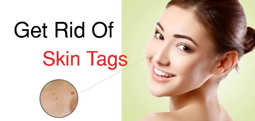 Get Rid Of Skin Tags