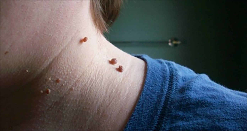 Skin tags on neck