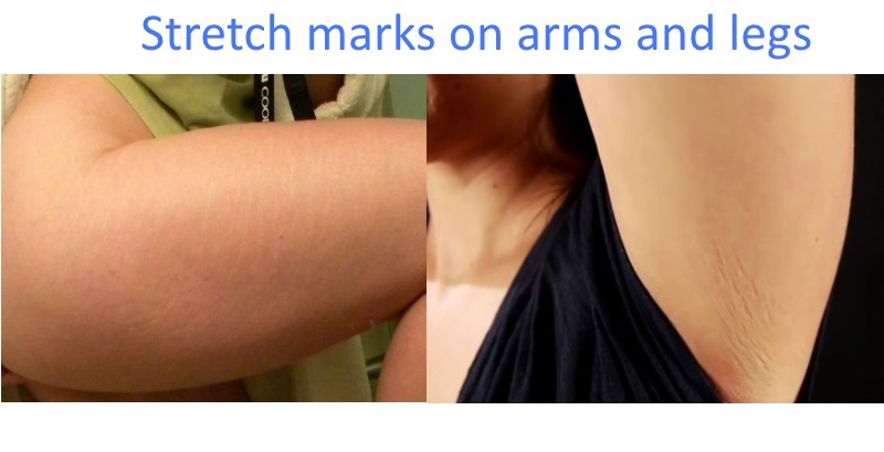 Stretch marks on arms and legs