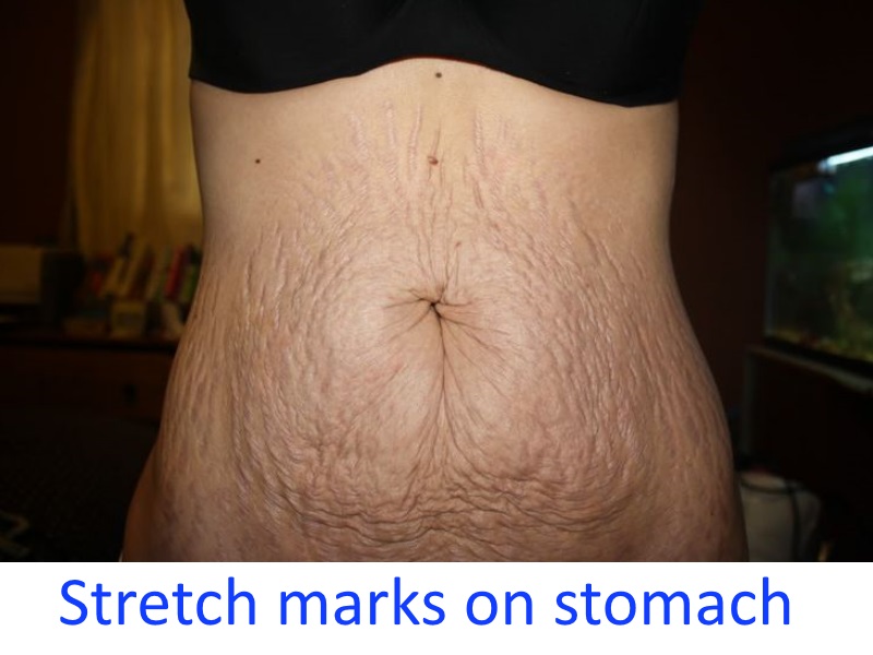 Stretch marks on stomach