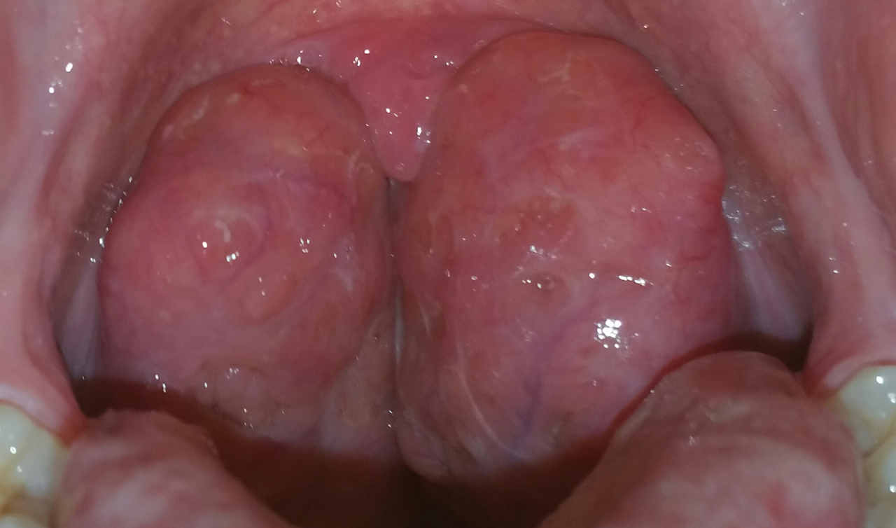 Swelling & Inflammation of Tonsils