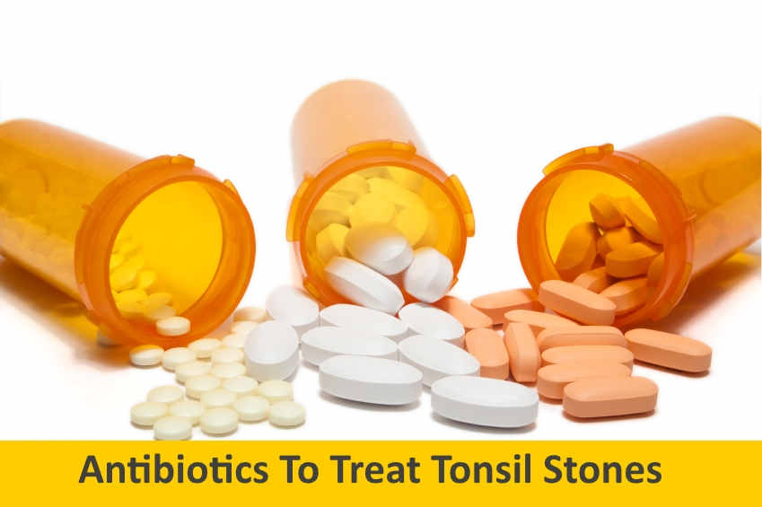 antibiotics to get rid of white spots on tonsils