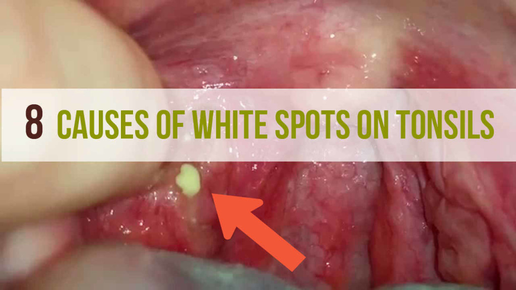 White Spots On Tonsils Causes Symptoms Treatment Risks   8 Causes Of White Spots On Tonsils 1024x576 