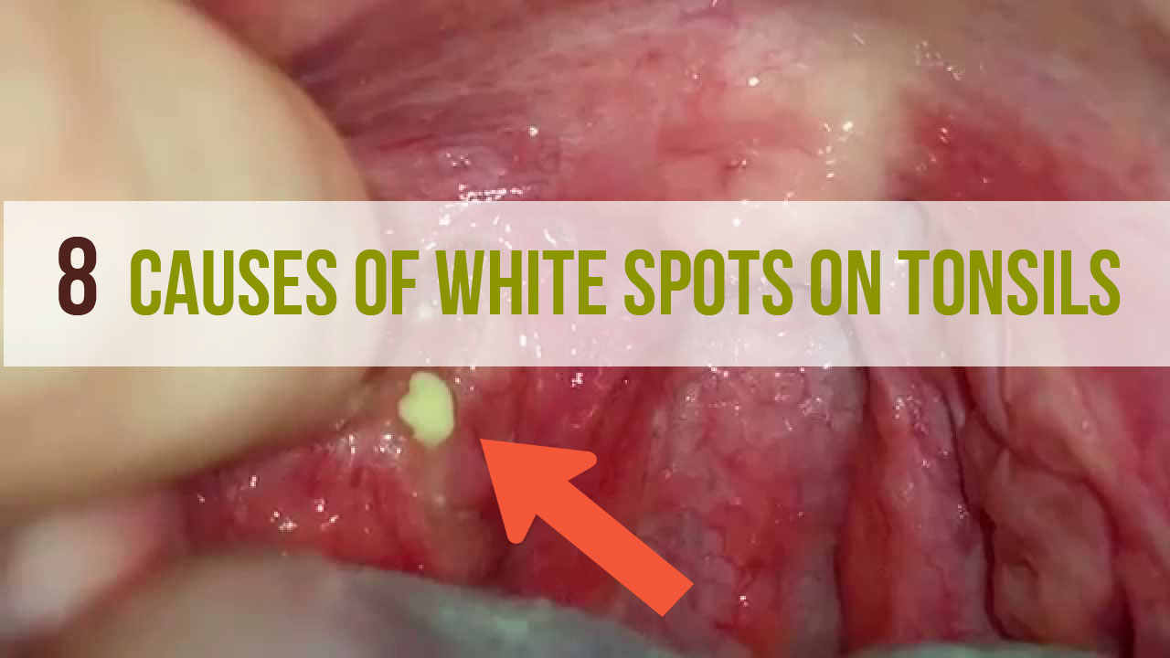 8 Causes of White Spots On Tonsils