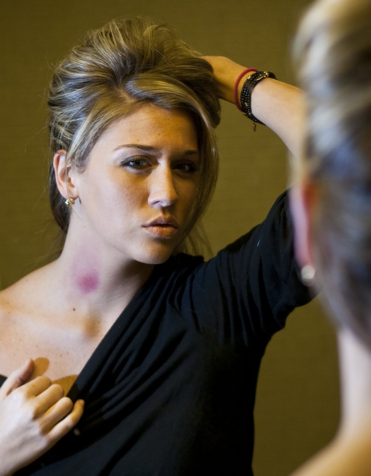 How Long Does A Hickey Last For If Left Untreated