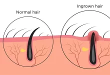 Home Remedies for Ingrown Hair