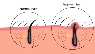 Home Remedies for Ingrown Hair