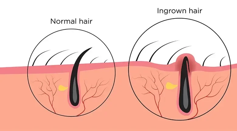 Home Remedies for Ingrown Hair