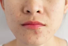 How To Get Rid Of Acne