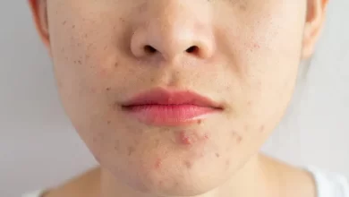 How To Get Rid Of Acne