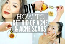 Apple Cider Vinegar To Cure Acne Scars