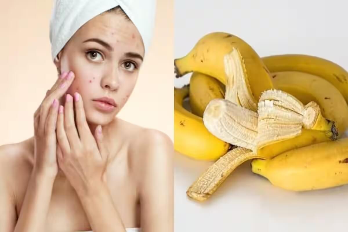 Banana Peel for Acne