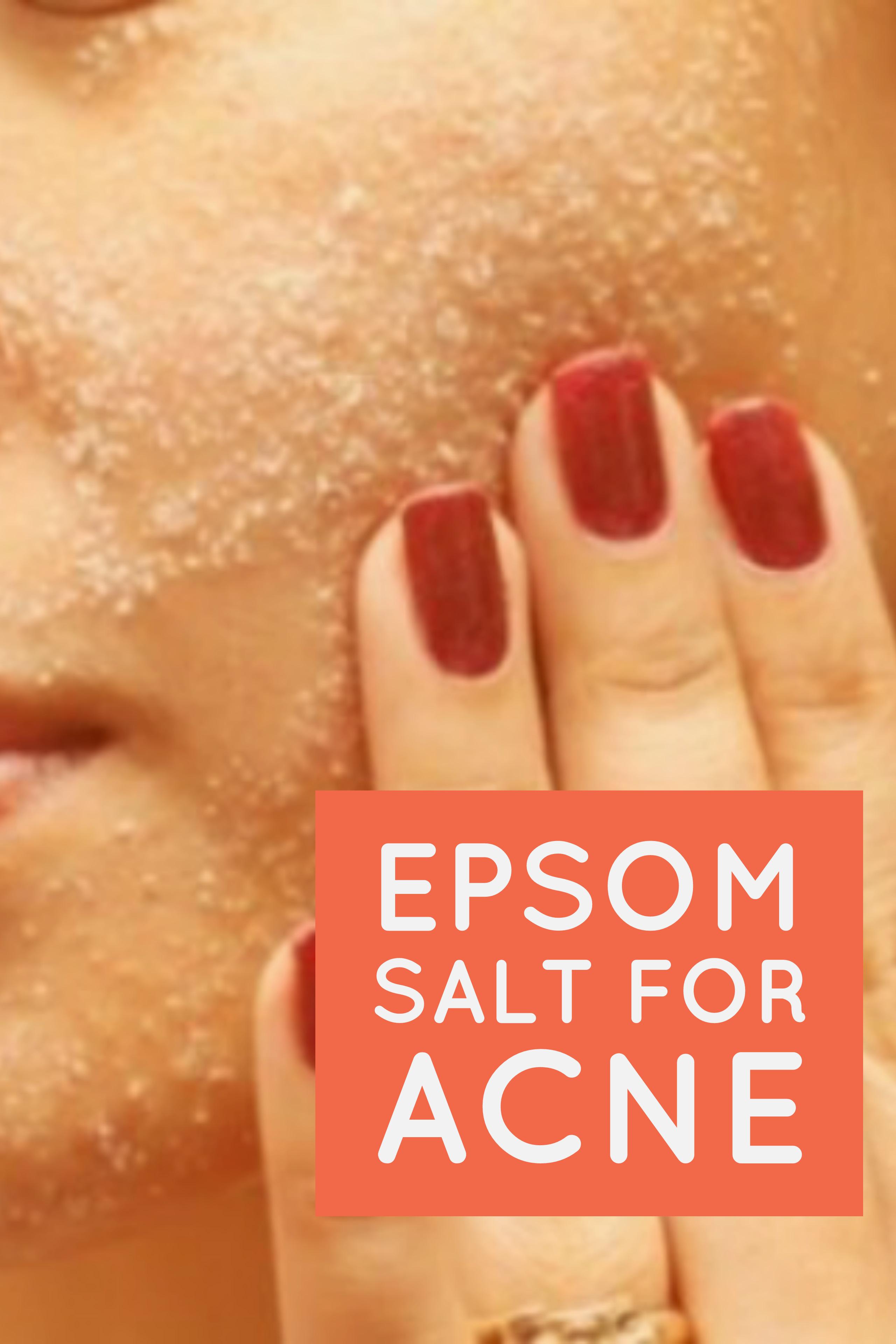 Epsom Salt for Acne