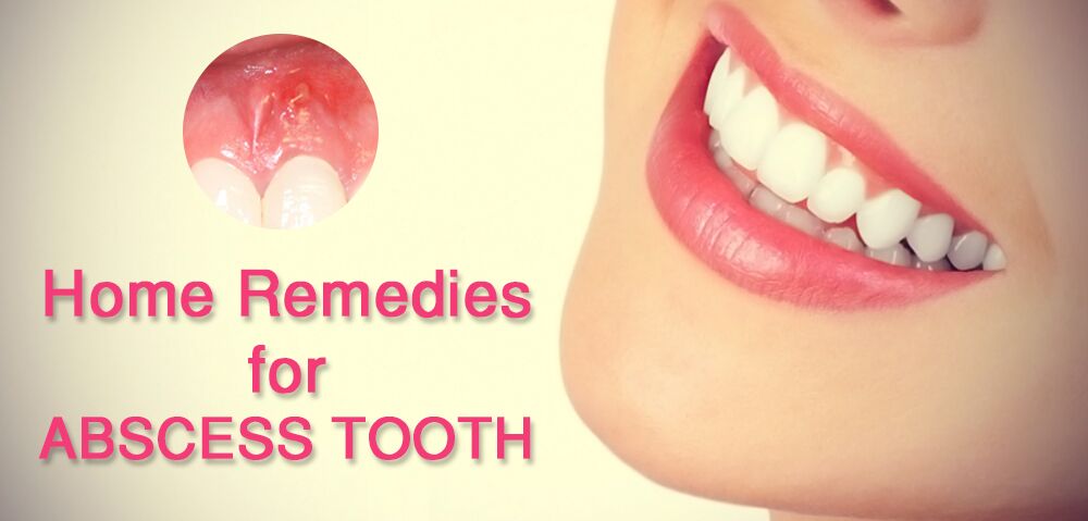Home Remedies for Abscess Tooth