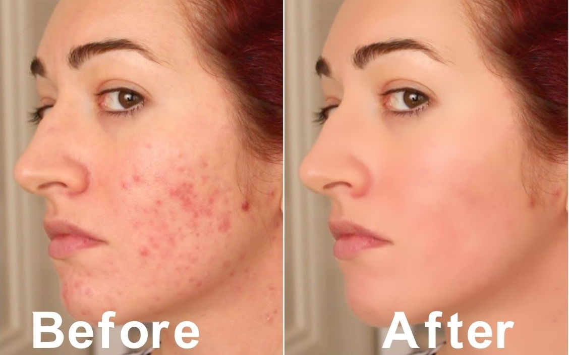 How to shrink open pores