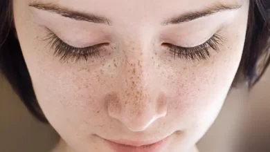 How to Get Rid of Freckles Fast