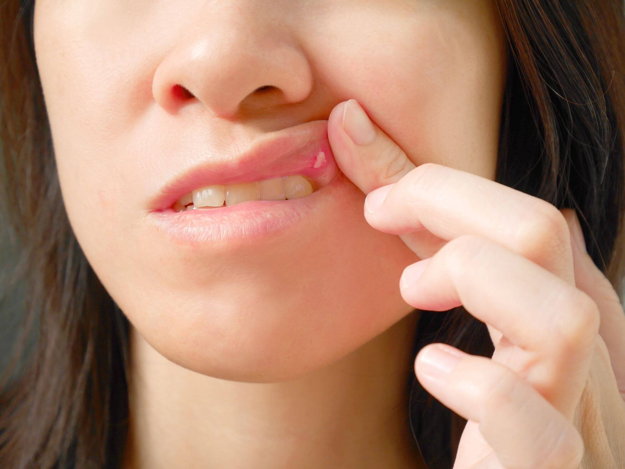 Treatment of Mouth Ulcers